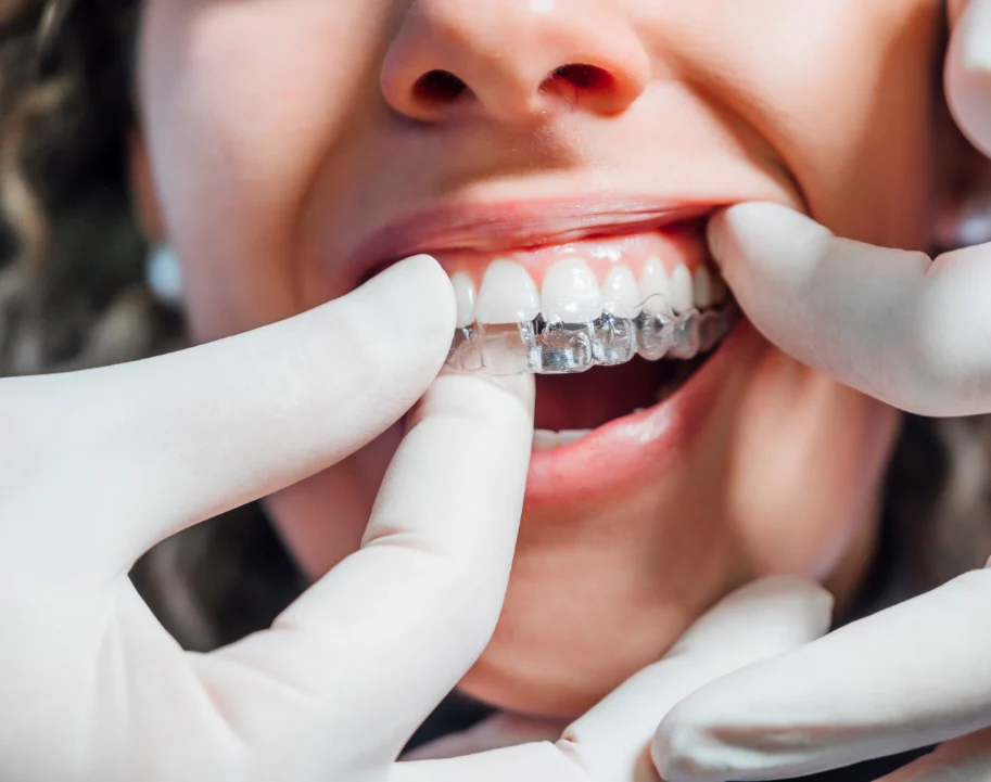Invisalign item being placed on the top teeth of a woman.