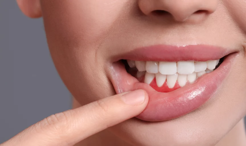 Person grabbing their lips and showing their gums/teeth