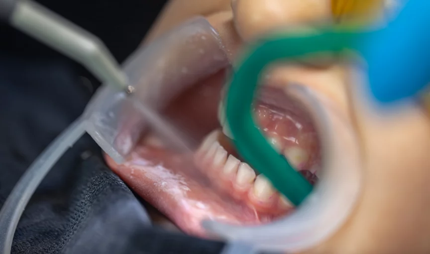 Close-up of a dental procedure with a patient's mouth open, dental suction and tools in use, and protective barriers in place.